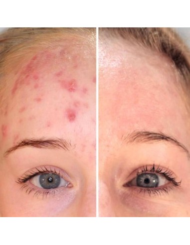 Biretix Micropeel Exfoliante 50 ml